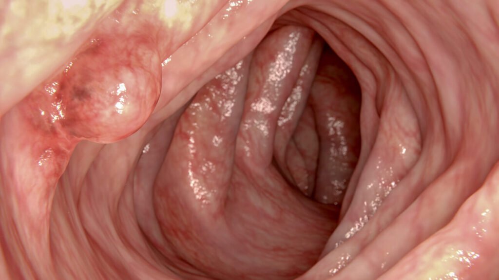 what is a colon polyp look like