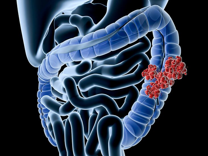 how to prevent colon polyps naturally