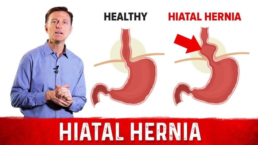 what is a hiatus hernia and what causes it